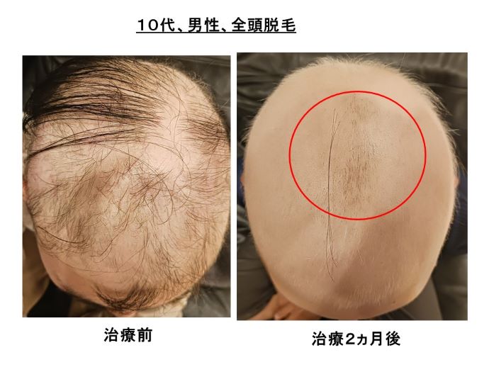 円形脱毛症　病院